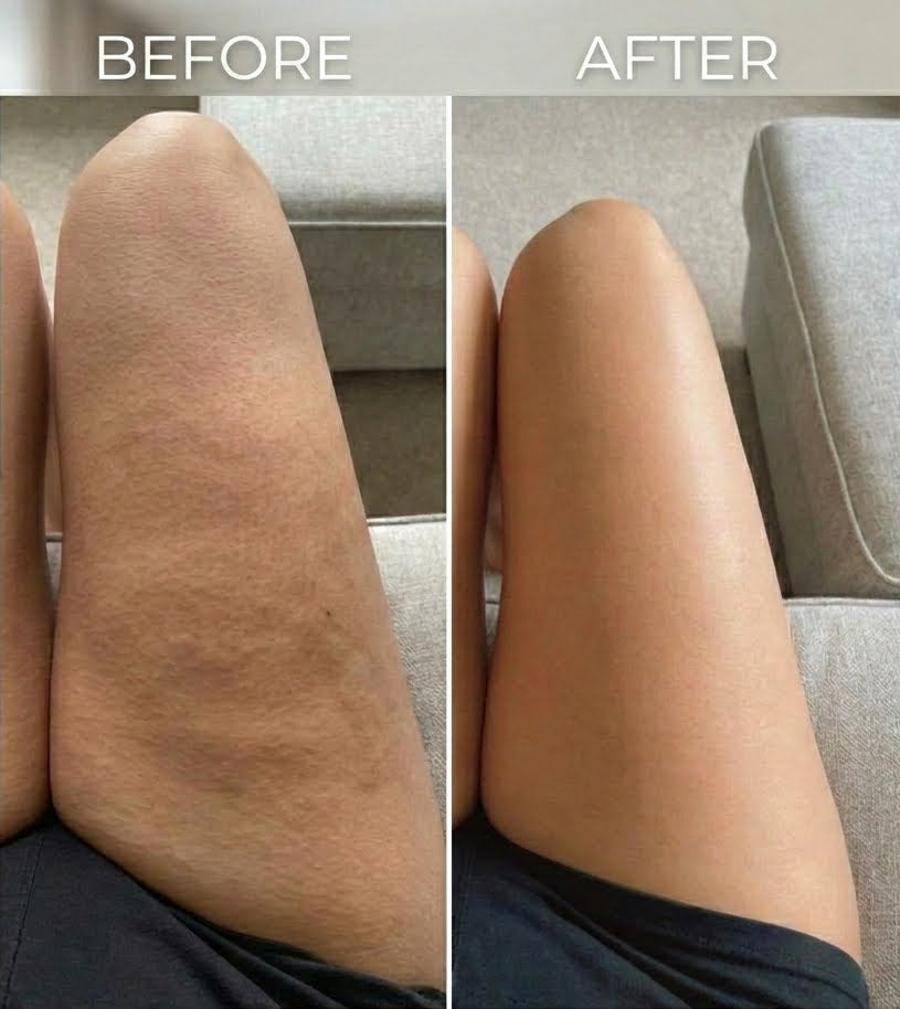SmoothBody™ Electric Cellulite Massager — Sculpt, Drain & Glow